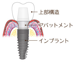 インプラント価格説明